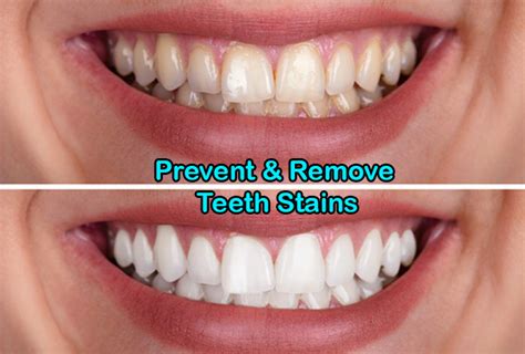 does honey stain teeth